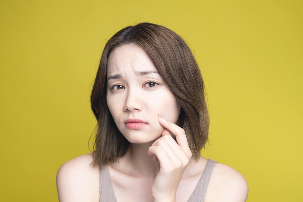 ニキビ跡に使える市販薬|改善の飲み薬と予防の塗り薬を紹介