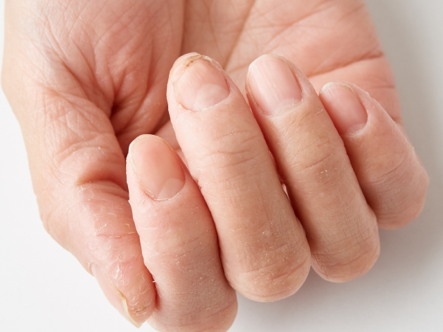 あかぎれの予防法|日常生活でできるセルフケア