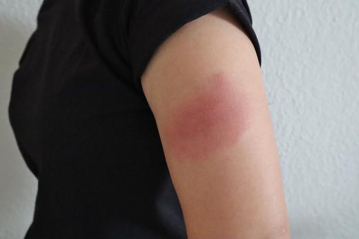 モデルナアームに使えるかゆみ止め薬|腕の腫れ・かゆみの対処法